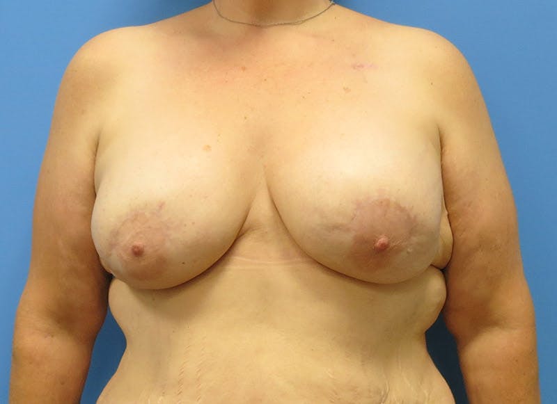Implant Reconstruction Before & After Gallery - Patient 112337891 - Image 6