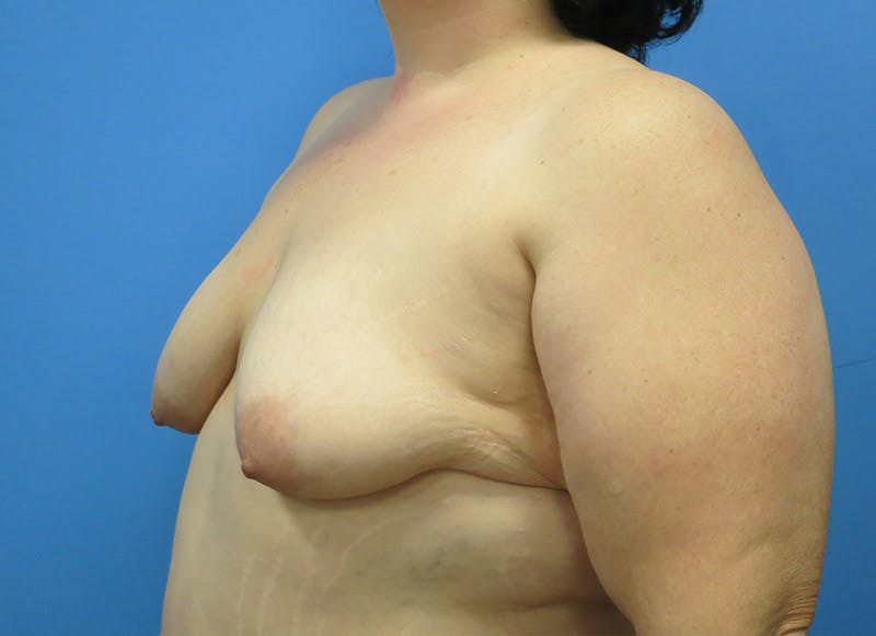 Implant Reconstruction Gallery Before & After Gallery - Patient 112337891 - Image 3