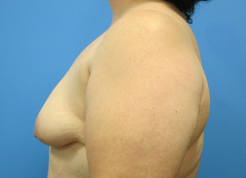 Implant Reconstruction Gallery Before & After Gallery - Patient 112337891 - Image 1