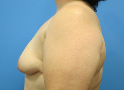 Implant Reconstruction Gallery Before & After Gallery - Patient 112337891 - Image 1