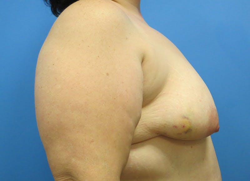 Implant Reconstruction Before & After Gallery - Patient 112337891 - Image 9
