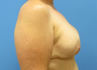 Implant Reconstruction Gallery Before & After Gallery - Patient 112337891 - Image 10