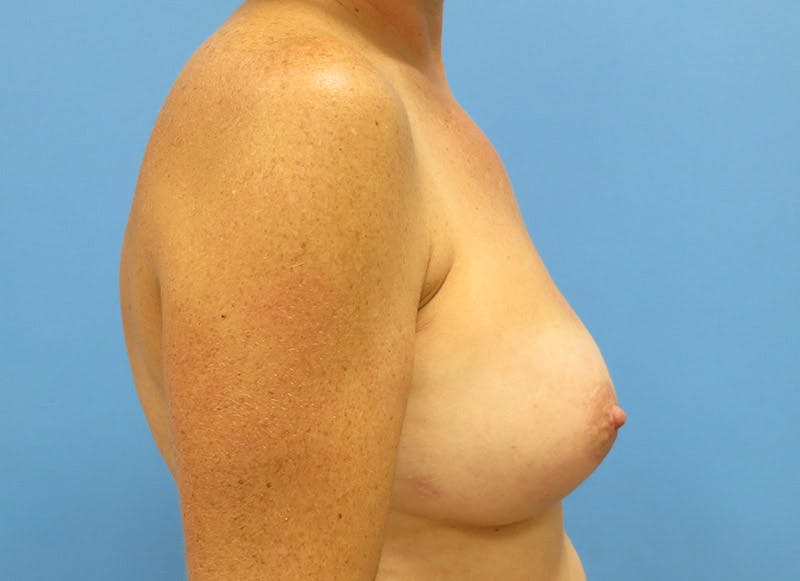 Implant Reconstruction Gallery Before & After Gallery - Patient 112337893 - Image 10