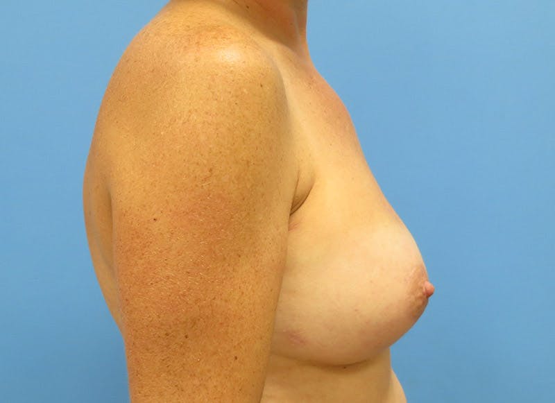 Implant Reconstruction Before & After Gallery - Patient 112337893 - Image 10