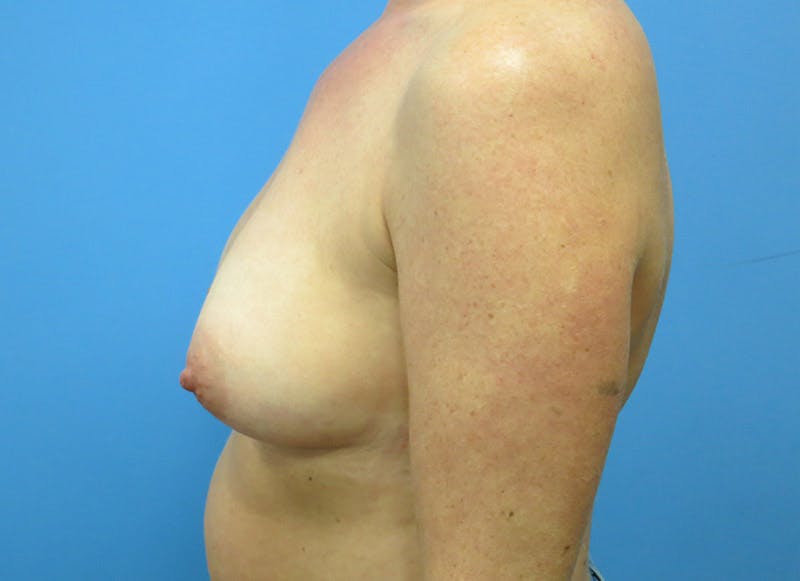 Implant Reconstruction Gallery Before & After Gallery - Patient 112337893 - Image 1