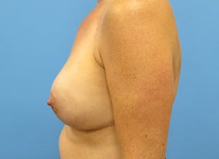 Implant Reconstruction Gallery Before & After Gallery - Patient 112337893 - Image 2