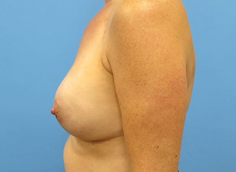Implant Reconstruction Before & After Gallery - Patient 112337893 - Image 2
