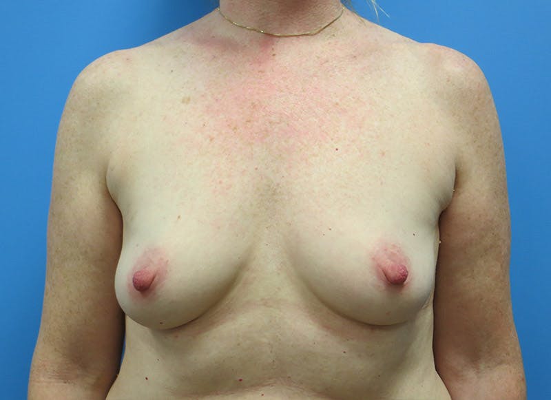 Implant Reconstruction Before & After Gallery - Patient 112337895 - Image 5