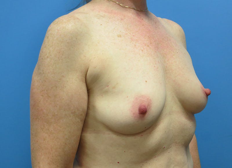 Implant Reconstruction Gallery Before & After Gallery - Patient 112337895 - Image 7