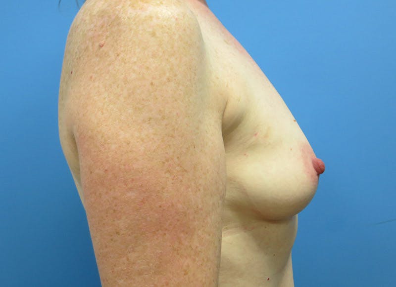 Implant Reconstruction Gallery Before & After Gallery - Patient 112337895 - Image 9