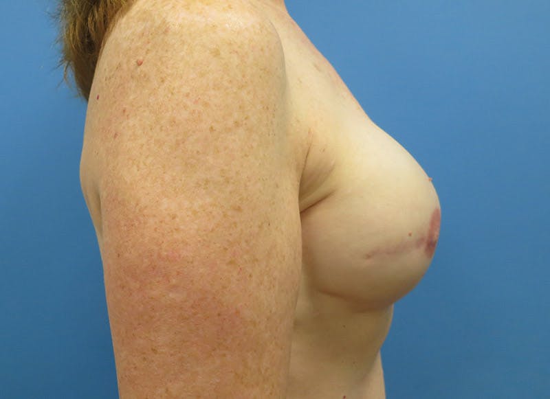 Implant Reconstruction Before & After Gallery - Patient 112337895 - Image 10