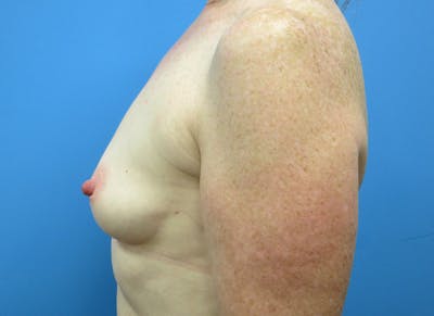 Implant Reconstruction Gallery Before & After Gallery - Patient 112337895 - Image 1