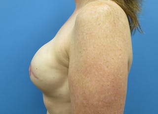 Implant Reconstruction Gallery Before & After Gallery - Patient 112337895 - Image 2