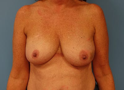 Implant Reconstruction Gallery Before & After Gallery - Patient 112337896 - Image 5