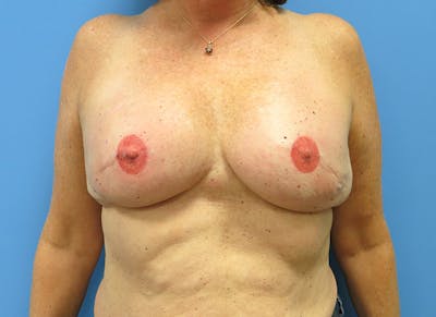 Implant Reconstruction Gallery Before & After Gallery - Patient 112337896 - Image 6