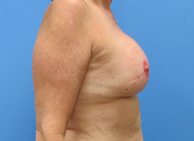 Implant Reconstruction Before & After Gallery - Patient 112337896 - Image 10