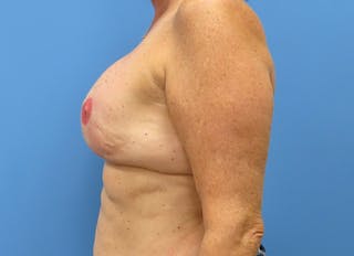 Implant Reconstruction Gallery Before & After Gallery - Patient 112337896 - Image 2