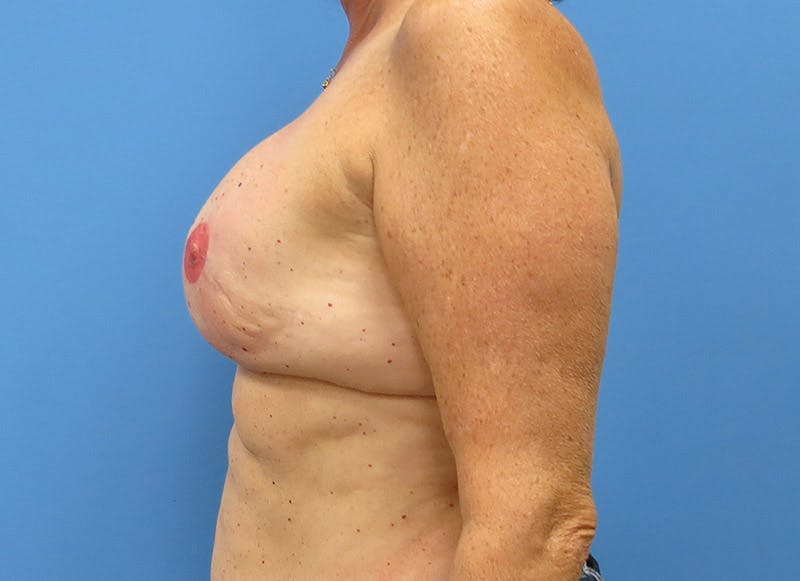 Implant Reconstruction Before & After Gallery - Patient 112337896 - Image 2