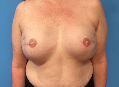 Implant Reconstruction Gallery Before & After Gallery - Patient 112337898 - Image 6