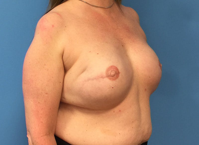 Implant Reconstruction Gallery Before & After Gallery - Patient 112337898 - Image 8