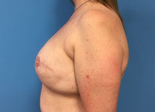 Implant Reconstruction Gallery Before & After Gallery - Patient 112337898 - Image 2