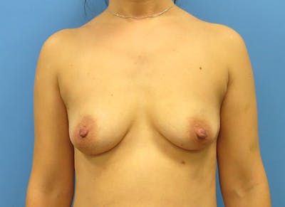 Implant Reconstruction Before & After Gallery - Patient 112337904 - Image 5