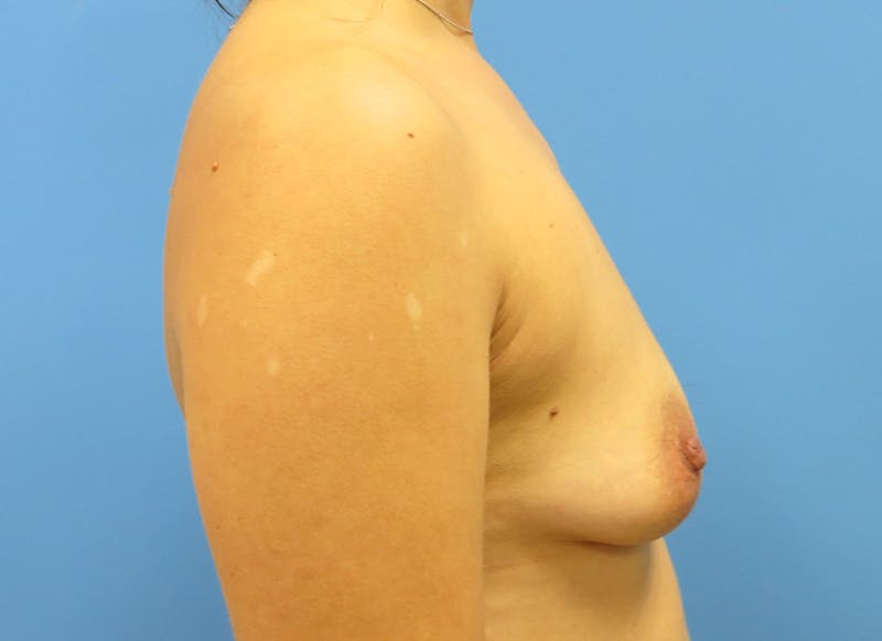 Implant Reconstruction Before & After Gallery - Patient 112337904 - Image 9