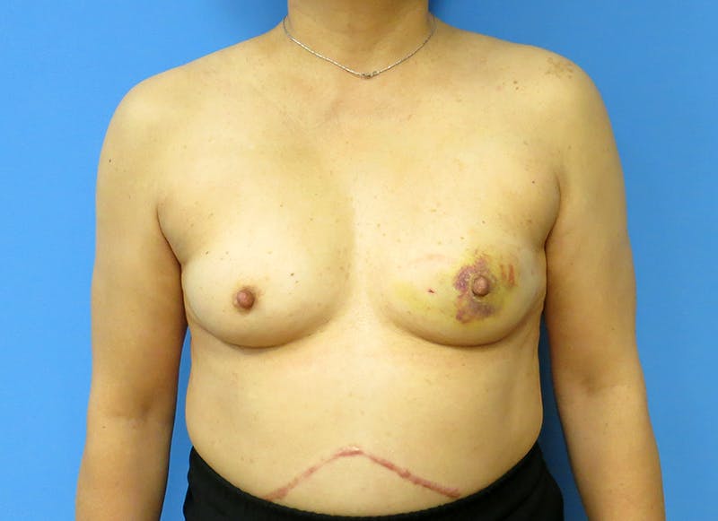 Implant Reconstruction Before & After Gallery - Patient 112337905 - Image 5