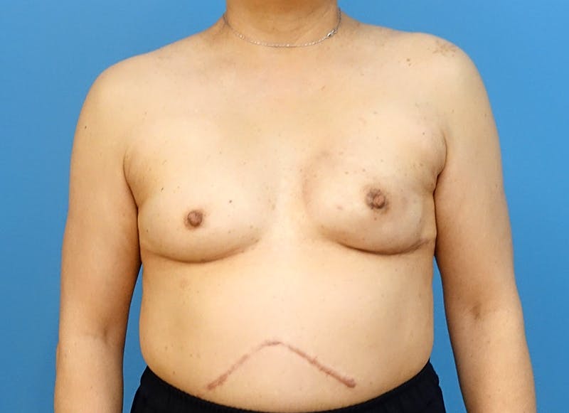 Implant Reconstruction Before & After Gallery - Patient 112337905 - Image 6