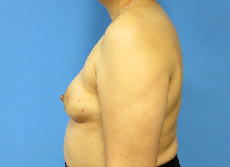 Implant Reconstruction Before & After Gallery - Patient 112337905 - Image 1