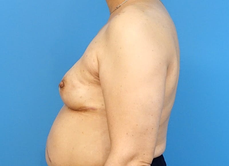 Implant Reconstruction Gallery Before & After Gallery - Patient 112337905 - Image 2