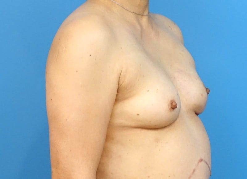 Implant Reconstruction Before & After Gallery - Patient 112337905 - Image 8