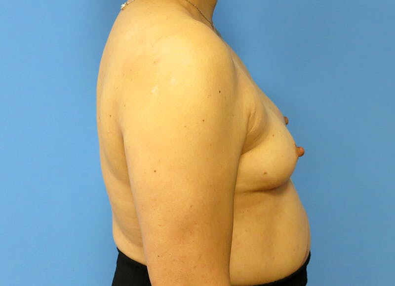 Implant Reconstruction Gallery Before & After Gallery - Patient 112337905 - Image 9