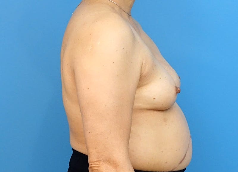 Implant Reconstruction Gallery Before & After Gallery - Patient 112337905 - Image 10