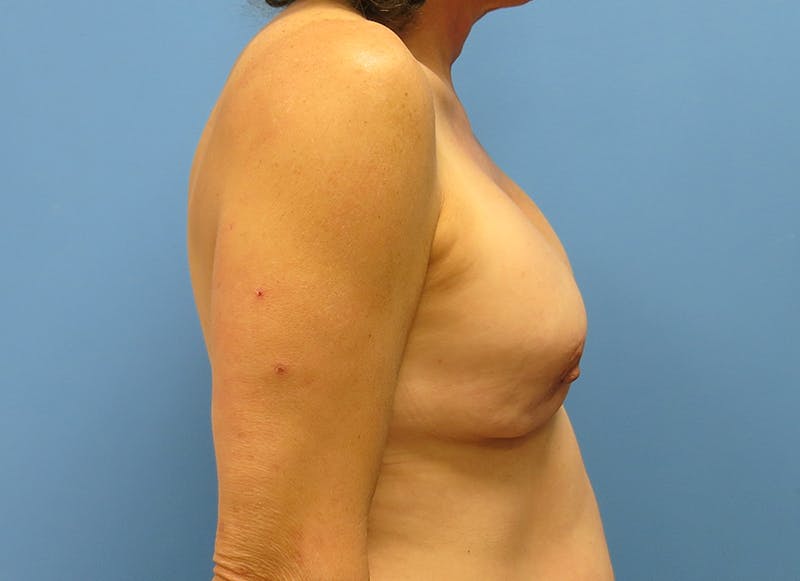 Implant Reconstruction Gallery Before & After Gallery - Patient 112337906 - Image 9