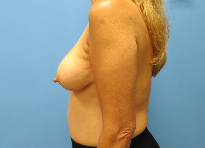 Implant Reconstruction Gallery Before & After Gallery - Patient 112337909 - Image 1