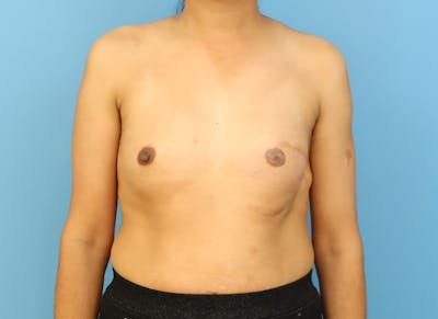 Implant Reconstruction Gallery Before & After Gallery - Patient 112337917 - Image 5