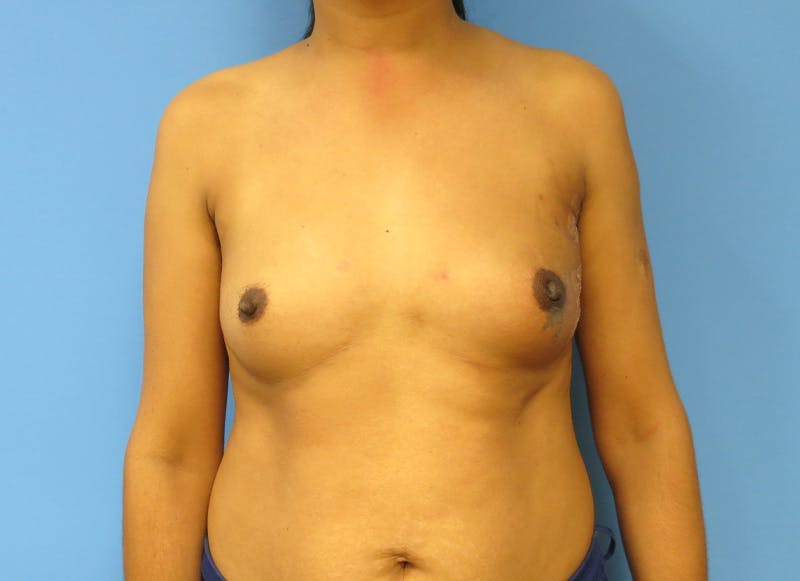 Implant Reconstruction Gallery Before & After Gallery - Patient 112337917 - Image 6