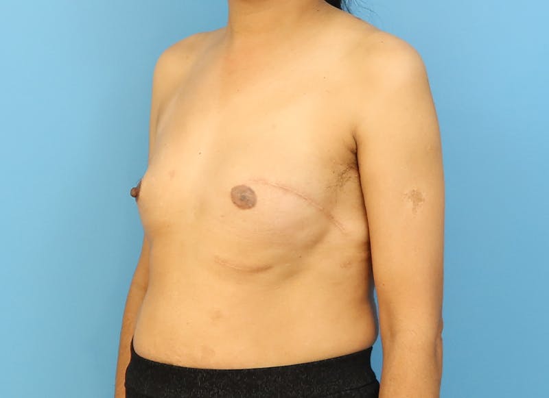 Implant Reconstruction Gallery Before & After Gallery - Patient 112337917 - Image 3