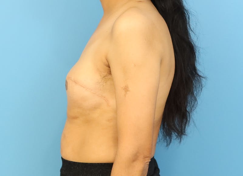 Implant Reconstruction Before & After Gallery - Patient 112337917 - Image 1