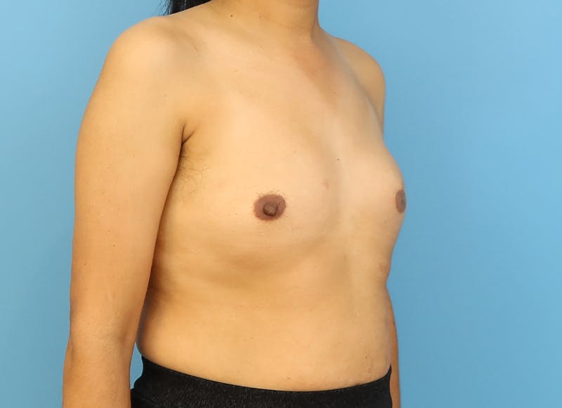 Implant Reconstruction Gallery Before & After Gallery - Patient 112337917 - Image 7