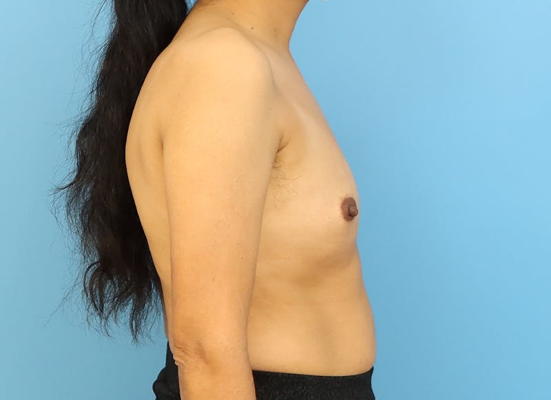 Implant Reconstruction Gallery Before & After Gallery - Patient 112337917 - Image 9
