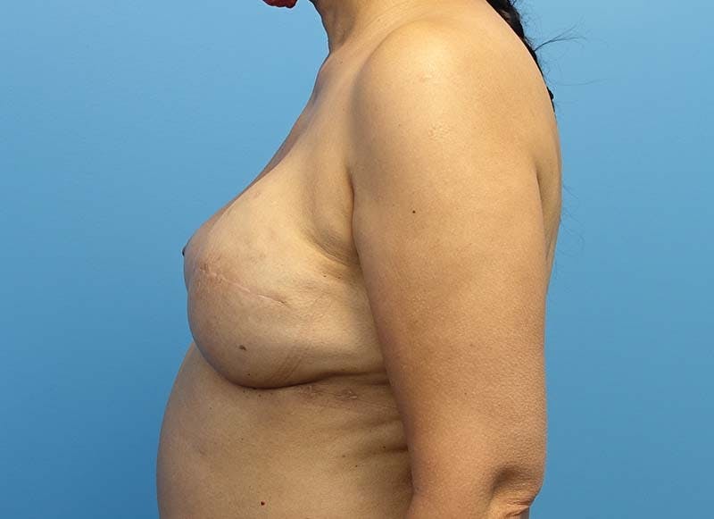 Implant Reconstruction Gallery Before & After Gallery - Patient 112337918 - Image 2