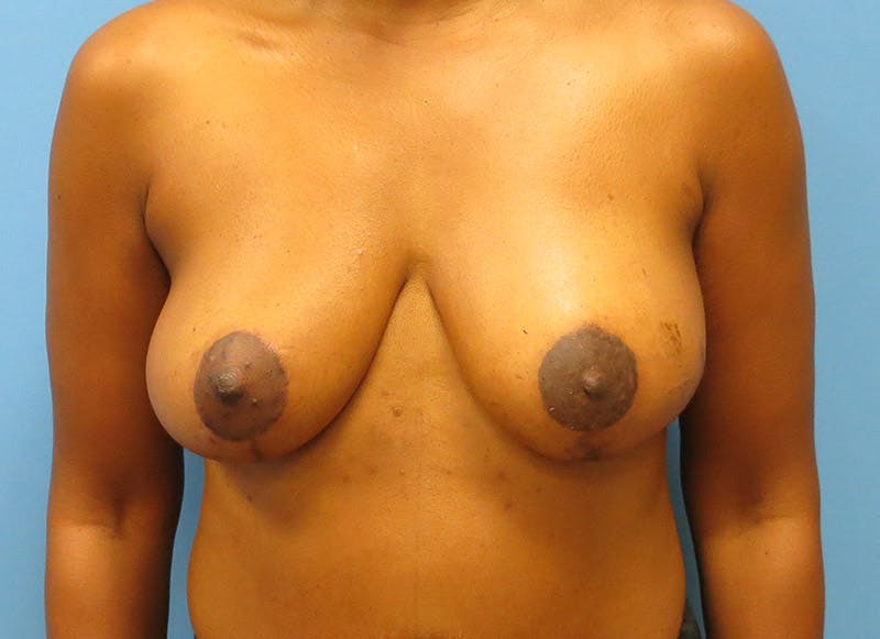 Flap Reconstruction Before & After Gallery - Patient 112337947 - Image 6