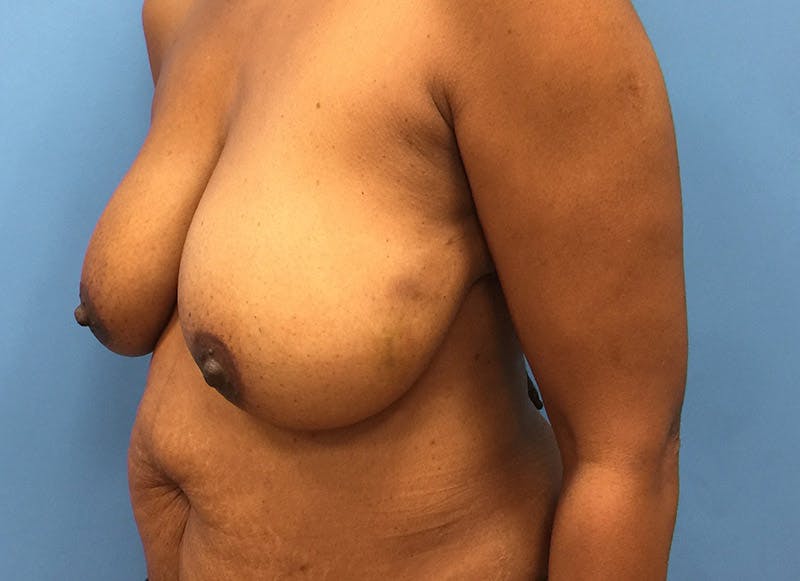 Flap Reconstruction Gallery Before & After Gallery - Patient 112337947 - Image 3