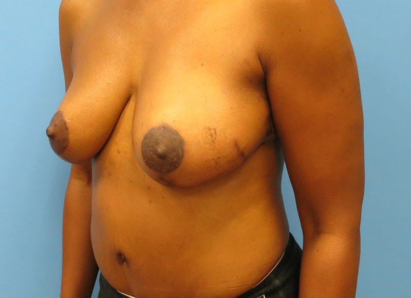 Flap Reconstruction Before & After Gallery - Patient 112337947 - Image 4