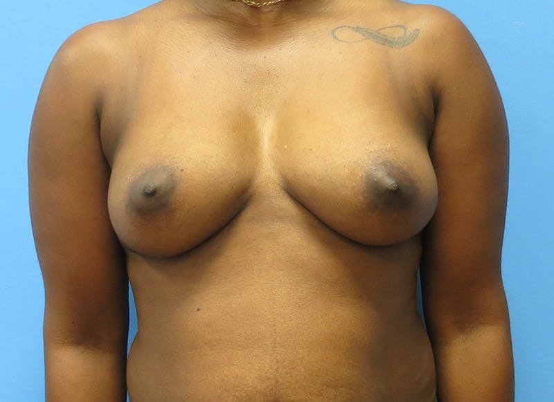 Flap Reconstruction Before & After Gallery - Patient 112337950 - Image 5