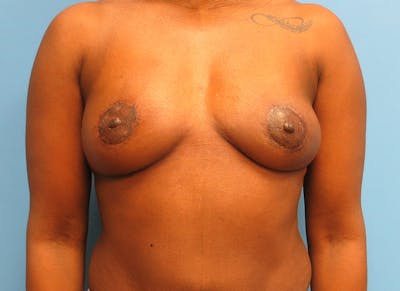 Flap Reconstruction Before & After Gallery - Patient 112337950 - Image 6