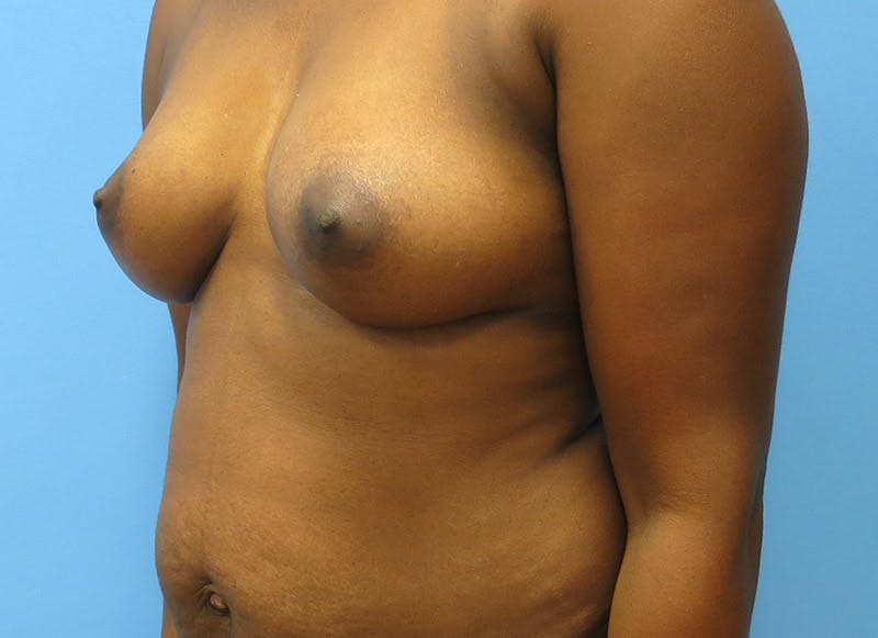 Flap Reconstruction Gallery Before & After Gallery - Patient 112337950 - Image 3