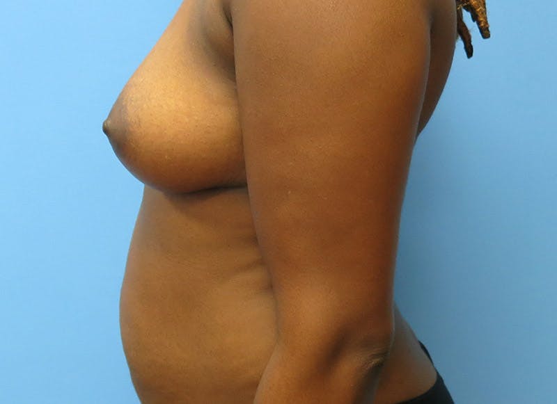Flap Reconstruction Gallery Before & After Gallery - Patient 112337950 - Image 1